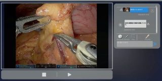AIが外科手術を支援、術中画像を見てアドバイス　慶應医学部発のスタートアップ - ITmedia